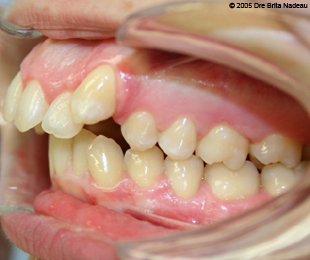 Marie-Hélène Cyr - Left lateral intraoral view - Before orthodontic treatments and orthognathic surgeries (November 24, 2005)